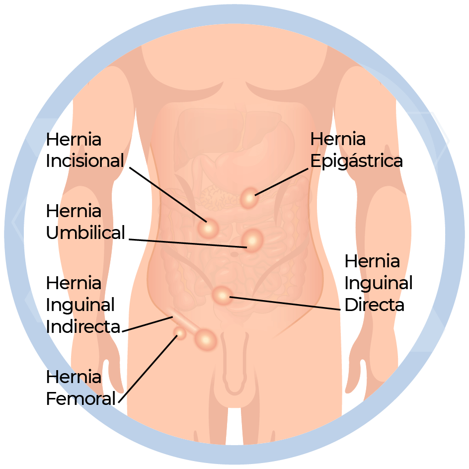 Cirugía Pared Abdominal - Hernia