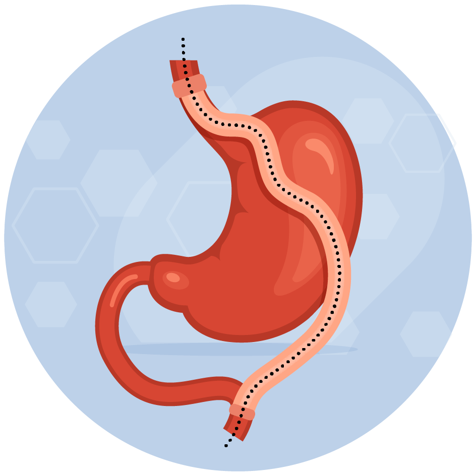 Cirugias-Obesidad-Alban-cirugias-bypass-2